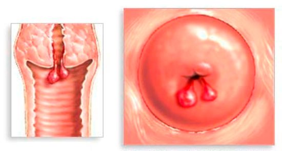 polyp cổ tử cung gây chảy máu